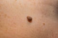 Papilloma on the skin of a womanÃ¢â¬â¢s neck. Soft focus, shallow depth of field Royalty Free Stock Photo